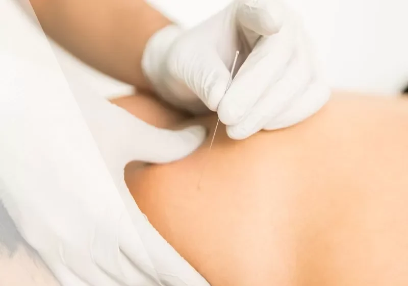 apw-blog-sep24-dryneedling-sq-jpg