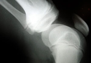 knee-arthritis-01